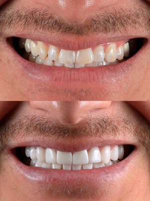 Antes y después del tratamiento profesional en Calident