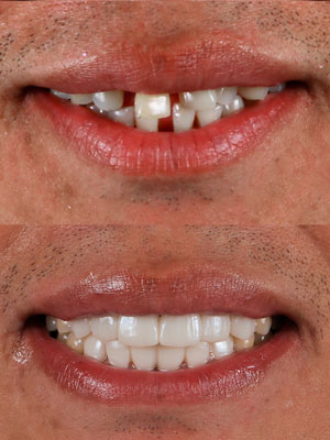 Tratamiento antes y después en calident resultados